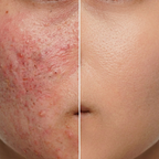 Glowteq Red Light Therapy Mask